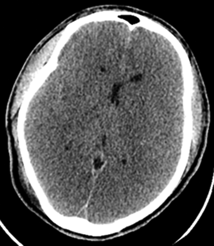 A Œdème cérébral diffus post-anoxique après un arrêt cardiaque prolongé