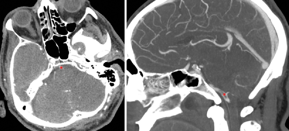 Thrombus visible au sein du tronc basilaire ( * ) en coupe axiale à gauche et sagittale à droite