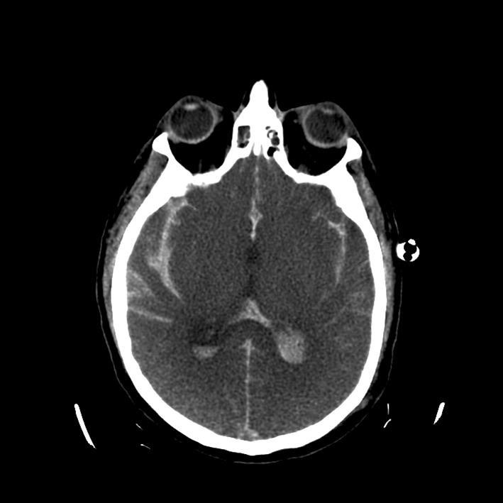 Coupe de scanner cérébral sans injection d'un patient après chute de sa hauteur