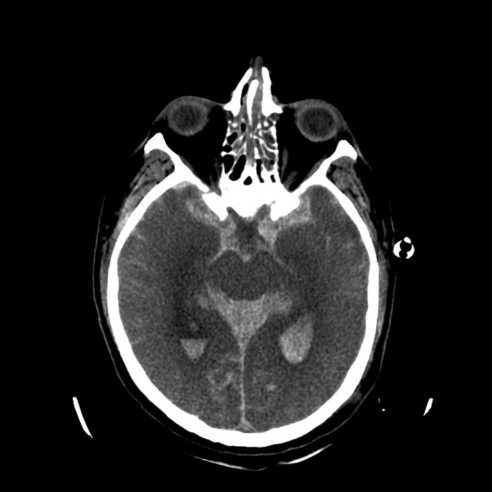 Coupe de scanner cérébral sans injection au niveau des orbites et des ventricules latéraux