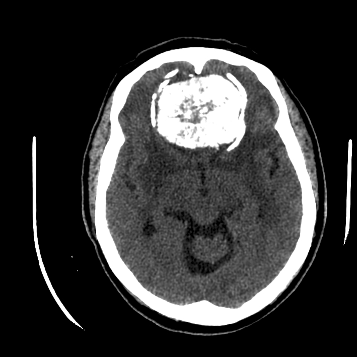Coupe de scanner cérébral axiale sans injection