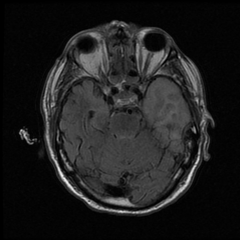 Coupe d'IRM cérébrale axiale en séquence FLAIR au niveau des orbites et des lobes temporaux
