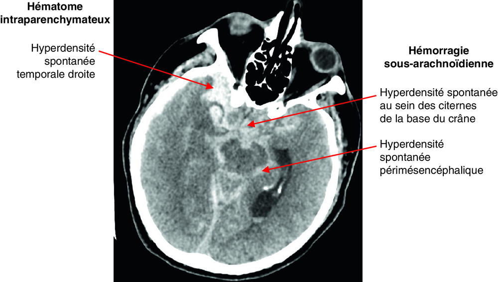 A Scanner cérébral sans injection, coupe axiale