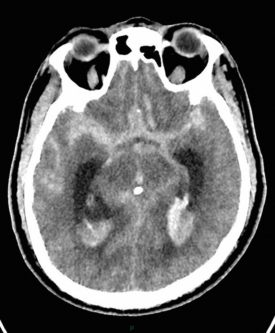 Coupe de scanner cérébral axial sans injection