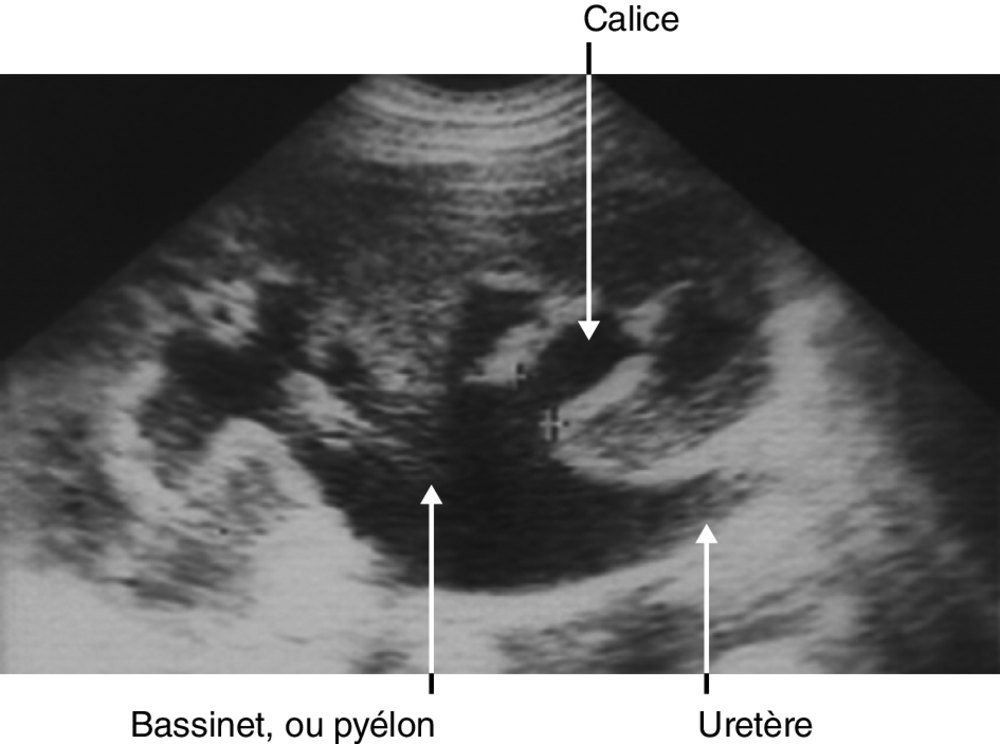 A Visualisation d’une dilatation des cavités pyélocalicielles à l’échographie. Le début de l’uretère dilaté est visible