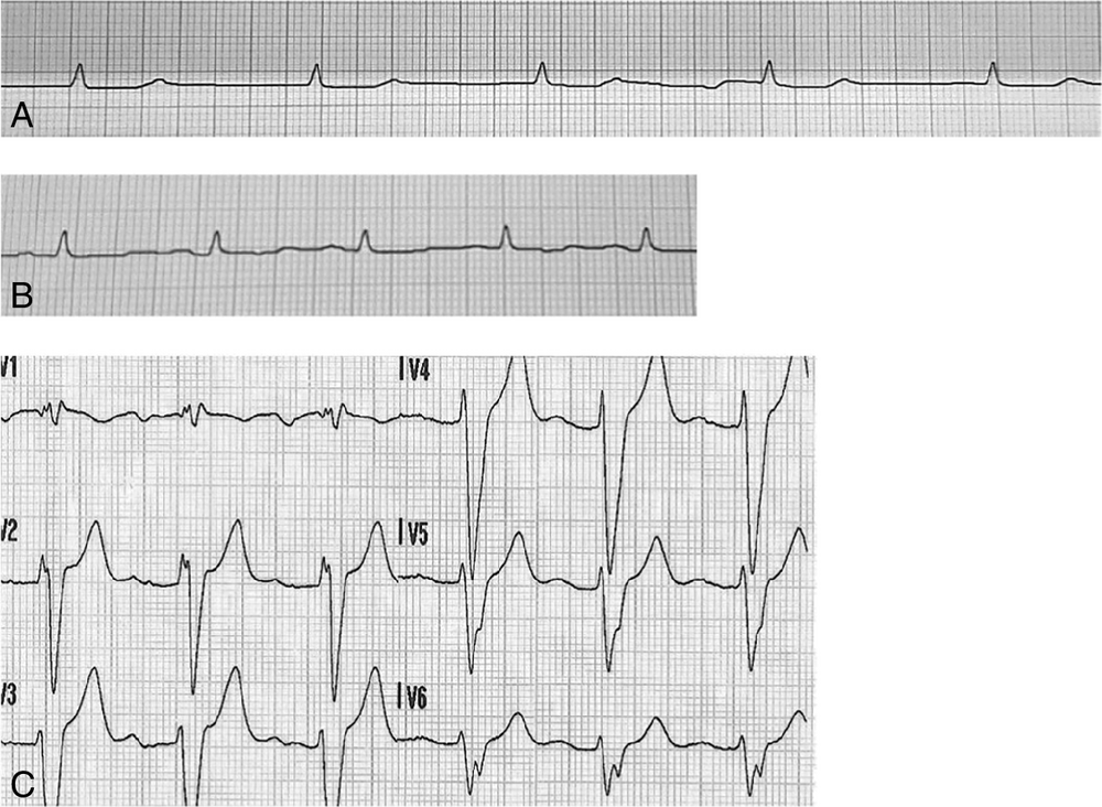 A ECG