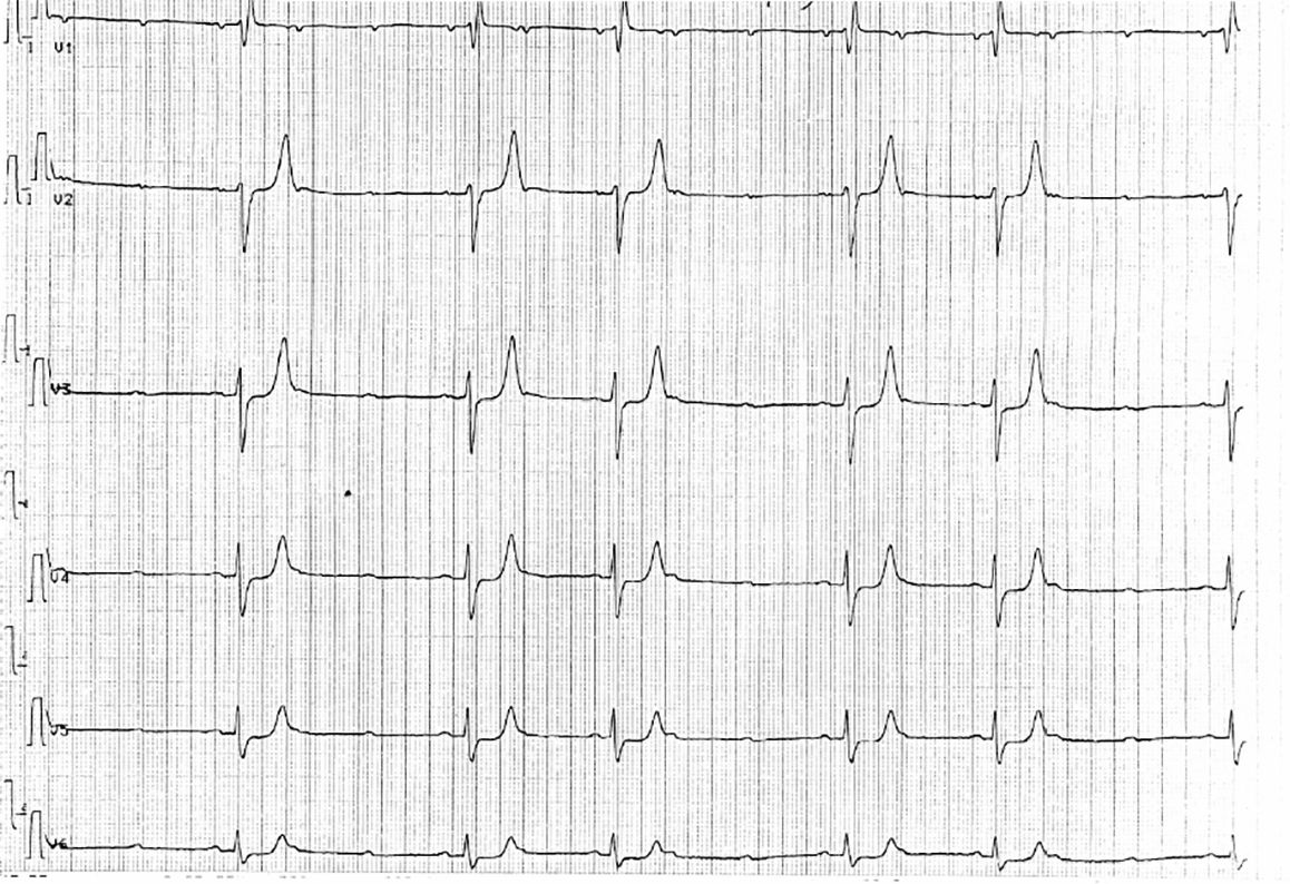 ECG des dérivations précordiales V1 à V6 du patient