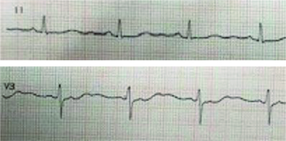 Deux tracés ECG des dérivations DII et V3