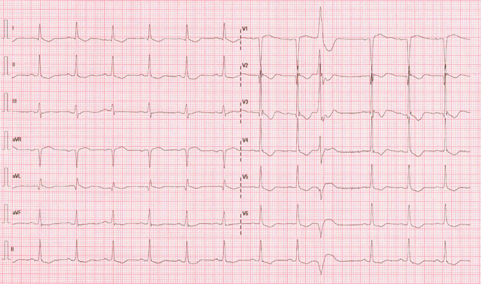 ECG 12 dérivations du patient