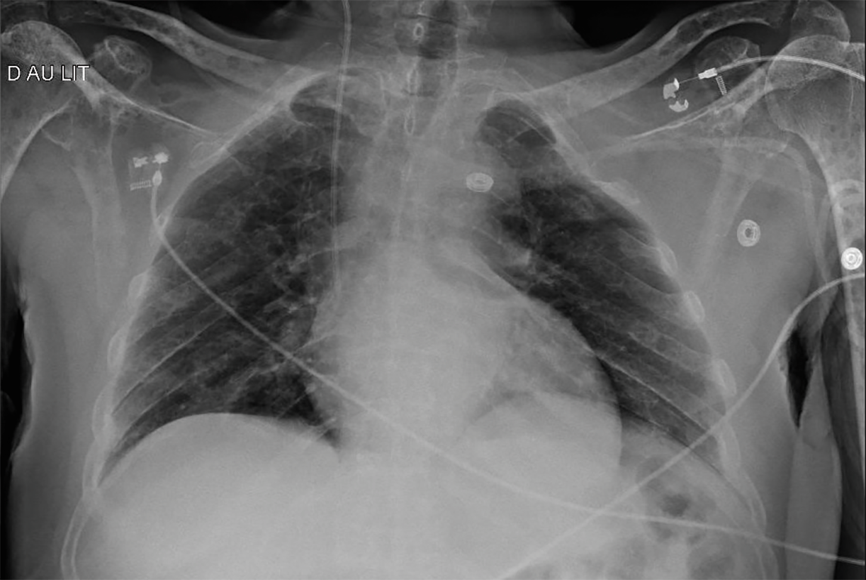 Radiographie thoracique de face au lit du patient, réalisée en urgence