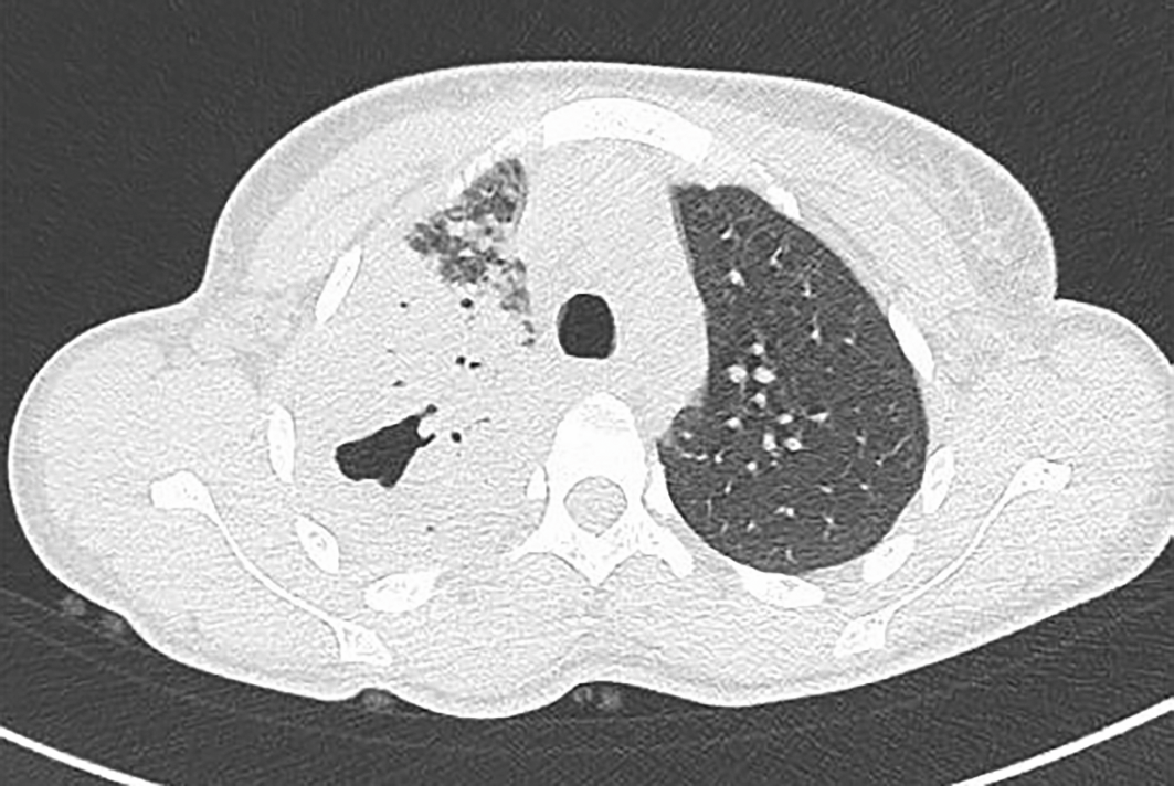 Coupe de scanner thoracique en fenêtre parenchymateuse, avec vue des deux poumons