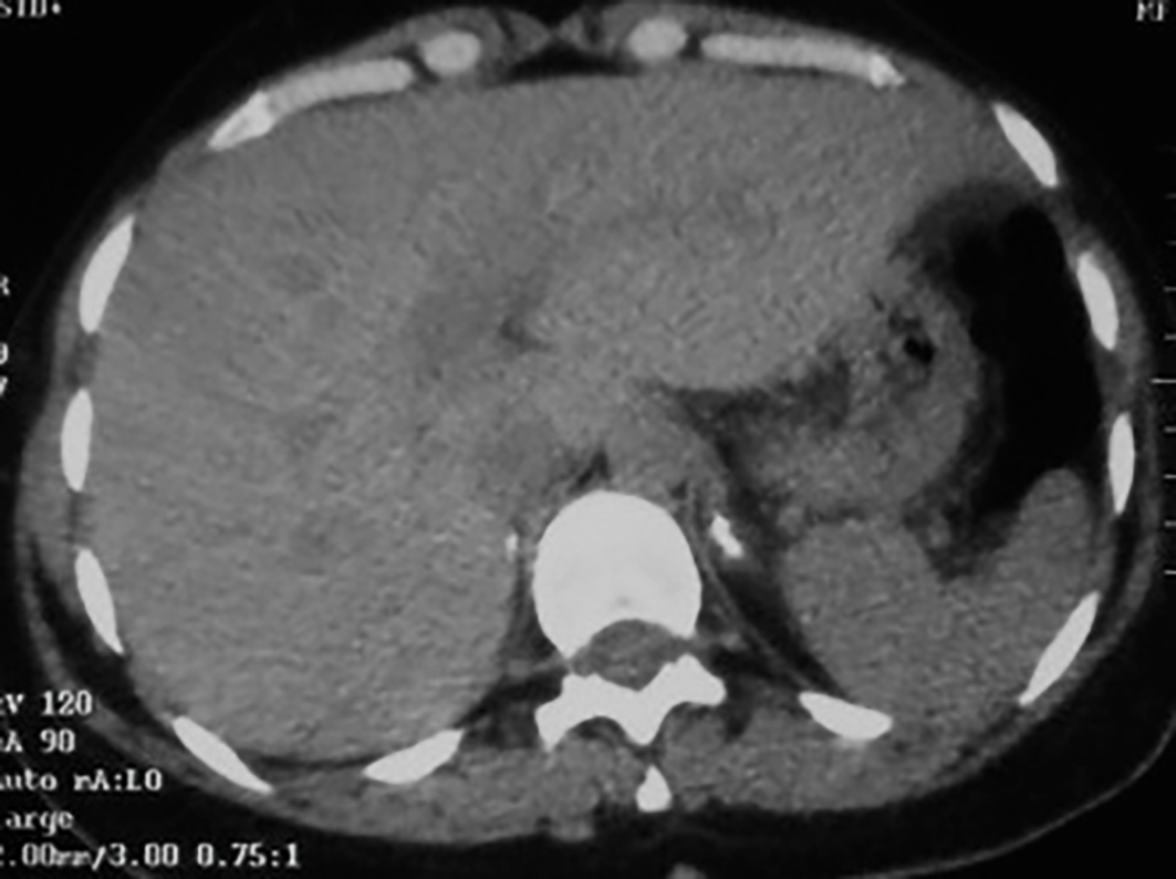 Coupe de scanner abdominal axial au niveau des surrénales
