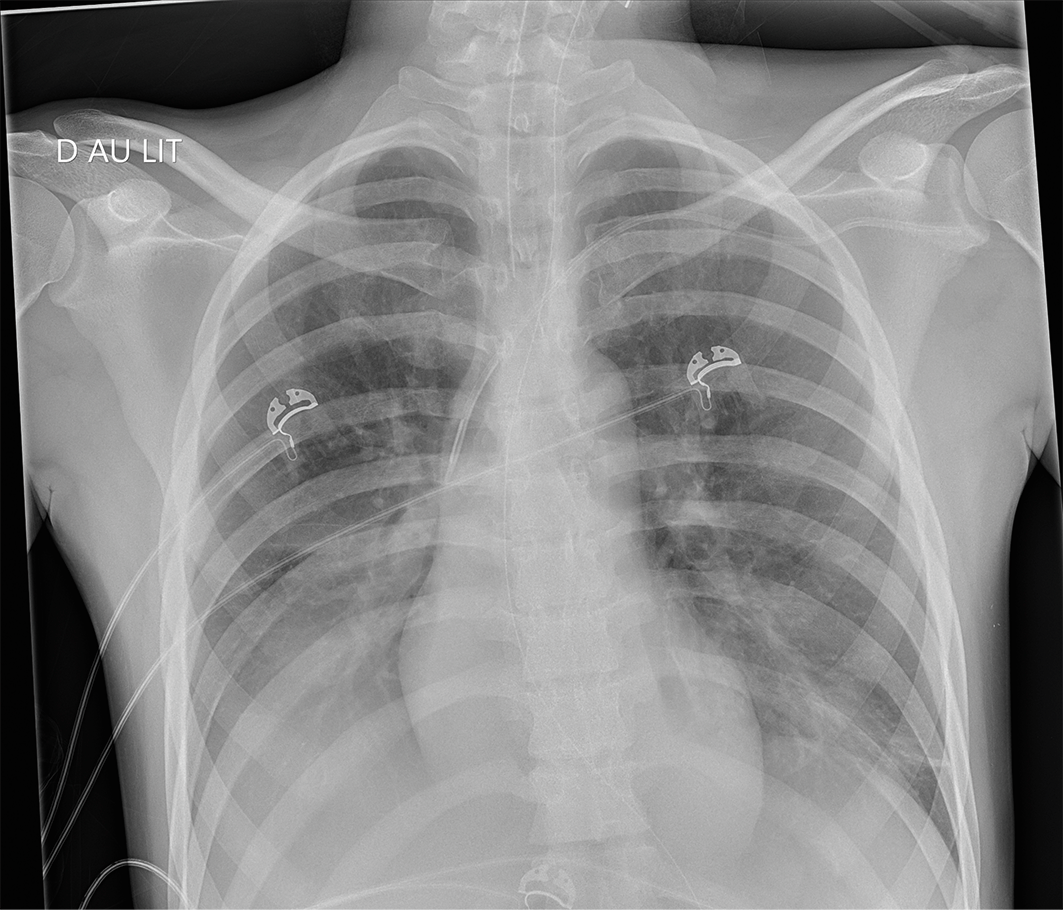Radiographie thoracique de face du patient