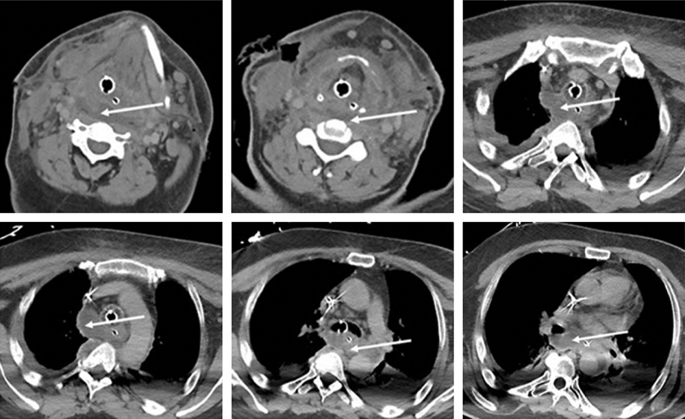 B Exemple de scanner cervicothoracique objectivant une cellulite cervicale avec infiltration rétropharyngée ayant diffusé dans le médiastin postérieur jusqu’au plan de…