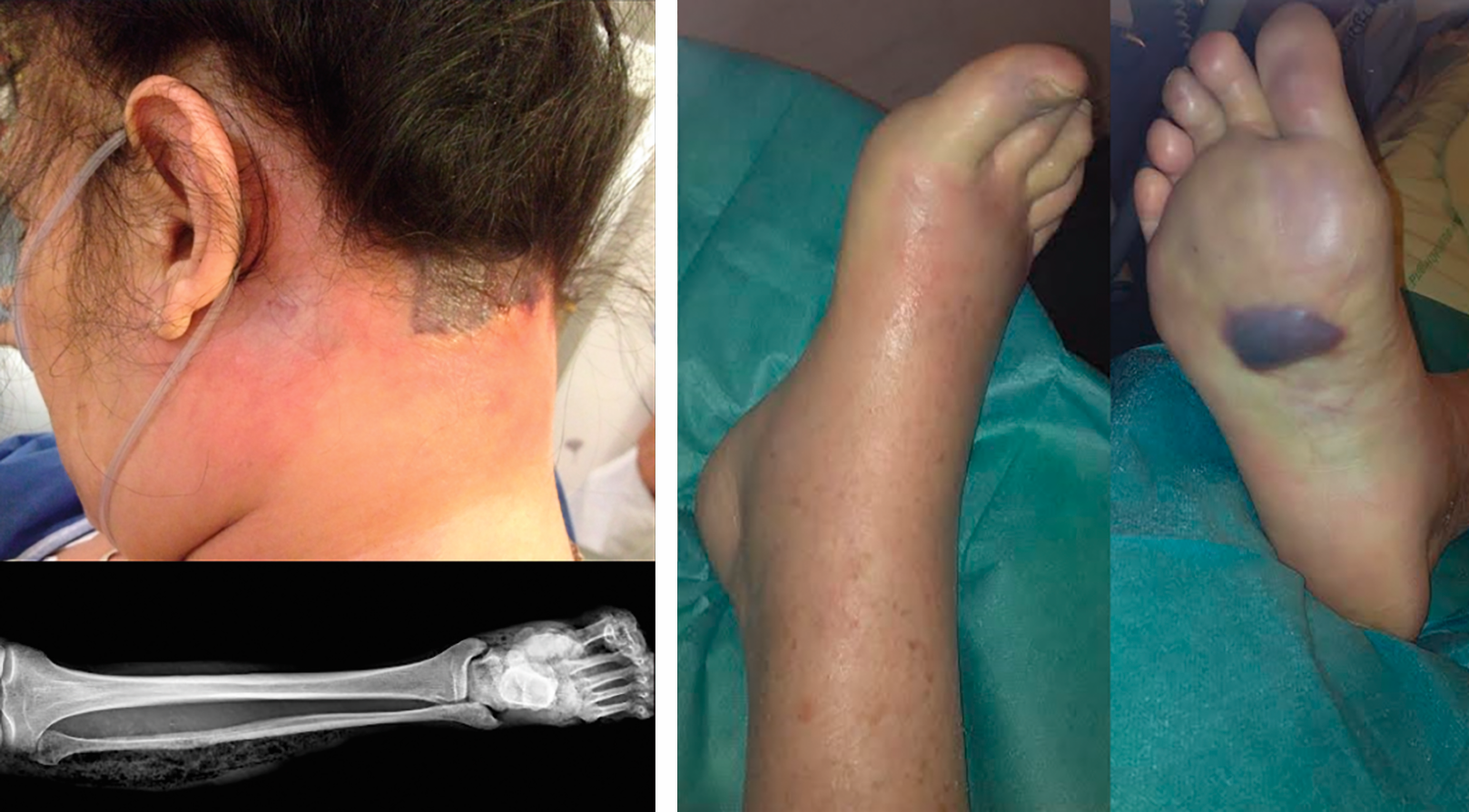 Planche de photographies de la nuque et du pied d'un patient et radiographie de jambe et pied