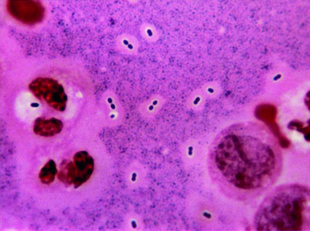 Examen direct du liquide cérébrospinal en coloration de Gram, vu au microscope