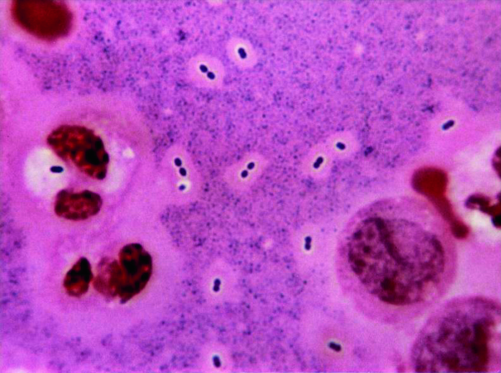Examen direct du liquide cérébrospinal en coloration de Gram, vu au microscope