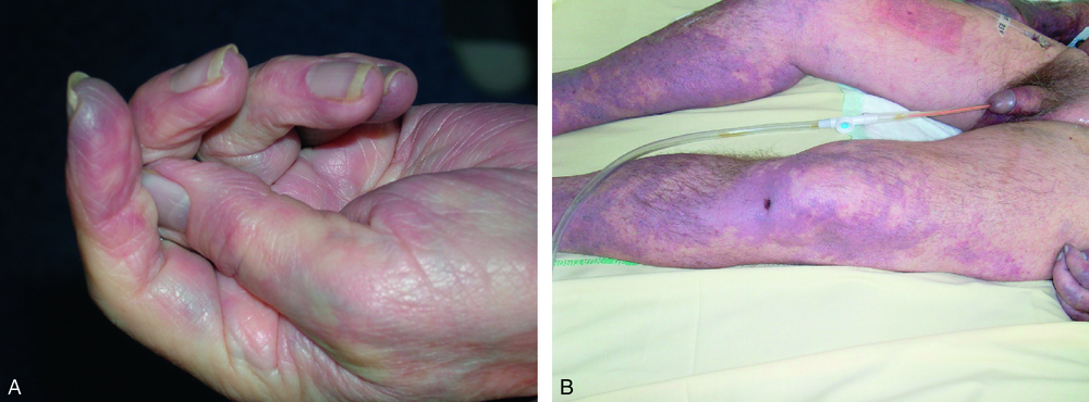 A Purpura fulminans à la phase initiale