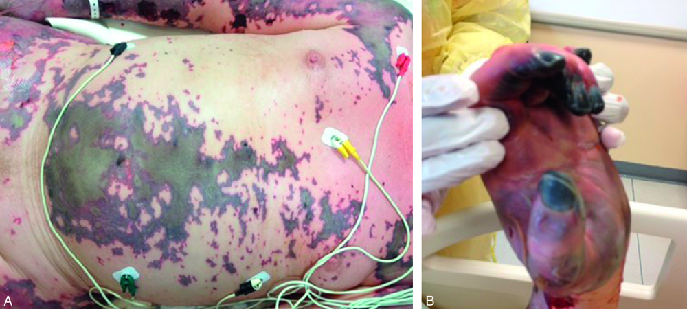 A Purpura fulminans à une phase évoluée