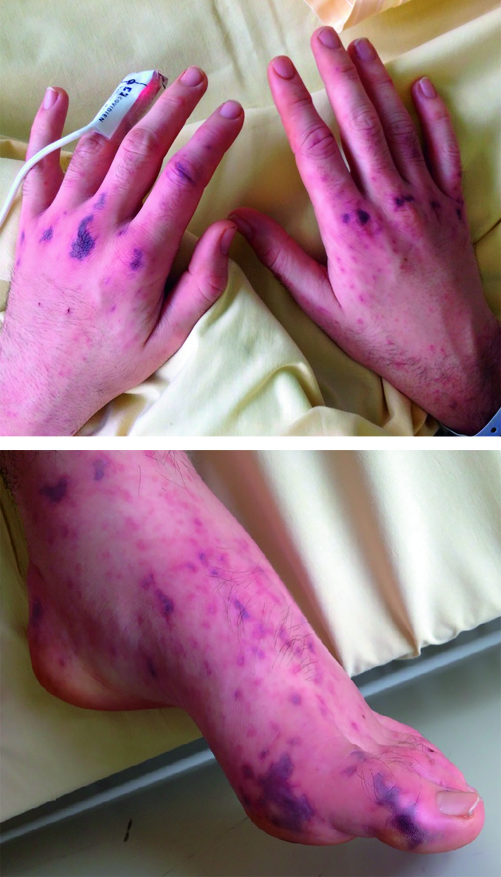 Photographie des deux mains et du pied d'un patient présentant des lésions cutanées