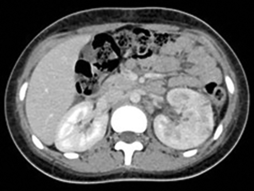 B Scanner injecté temps tardif. Pyélonéphrite aiguë gauche avec formation d’abcès sous-corticaux