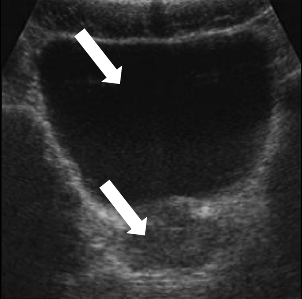 B Échographie sus-pubienne. Rétention aiguë d’urines (flèche du haut). Prostate volumineuse (flèche du bas)