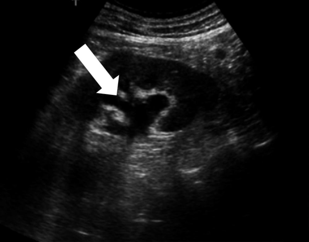 B Échographie rénale. Dilatation des cavités pyélocalicielles (flèche)