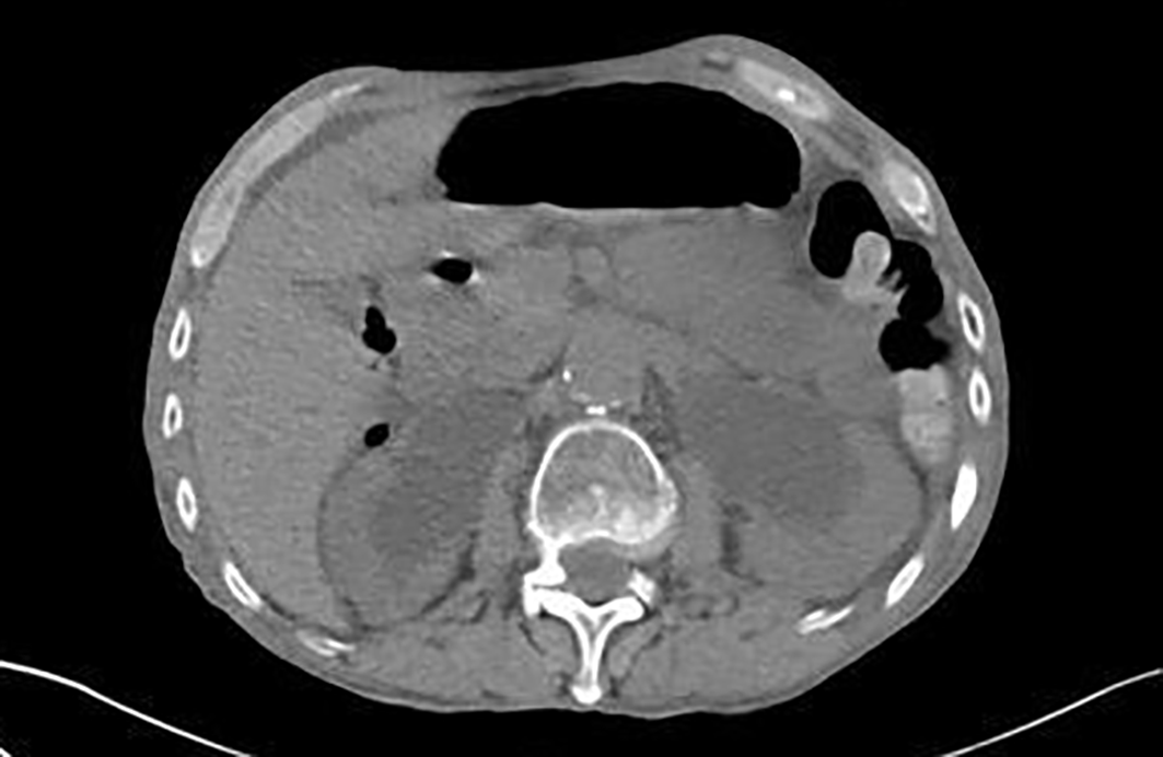 Coupe de scanner abdominopelvien sans injection au niveau des reins