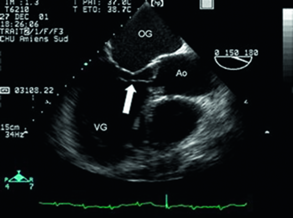 Échocardiographie transœsophagique avec flèche, cavités OG, VG et aorte annotées
