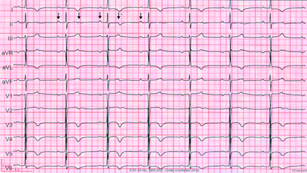 ECG 12 dérivations du patient au moment du choc