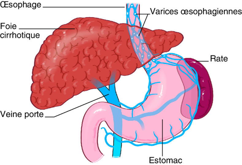 A Varices œsophagiennes sur hypertension portale secondaire à une cirrhose