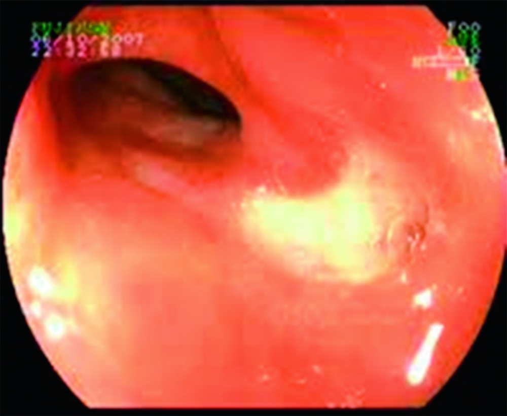 Image d'endoscopie digestive haute lors d'une fibroscopie œso-gastroduodénale