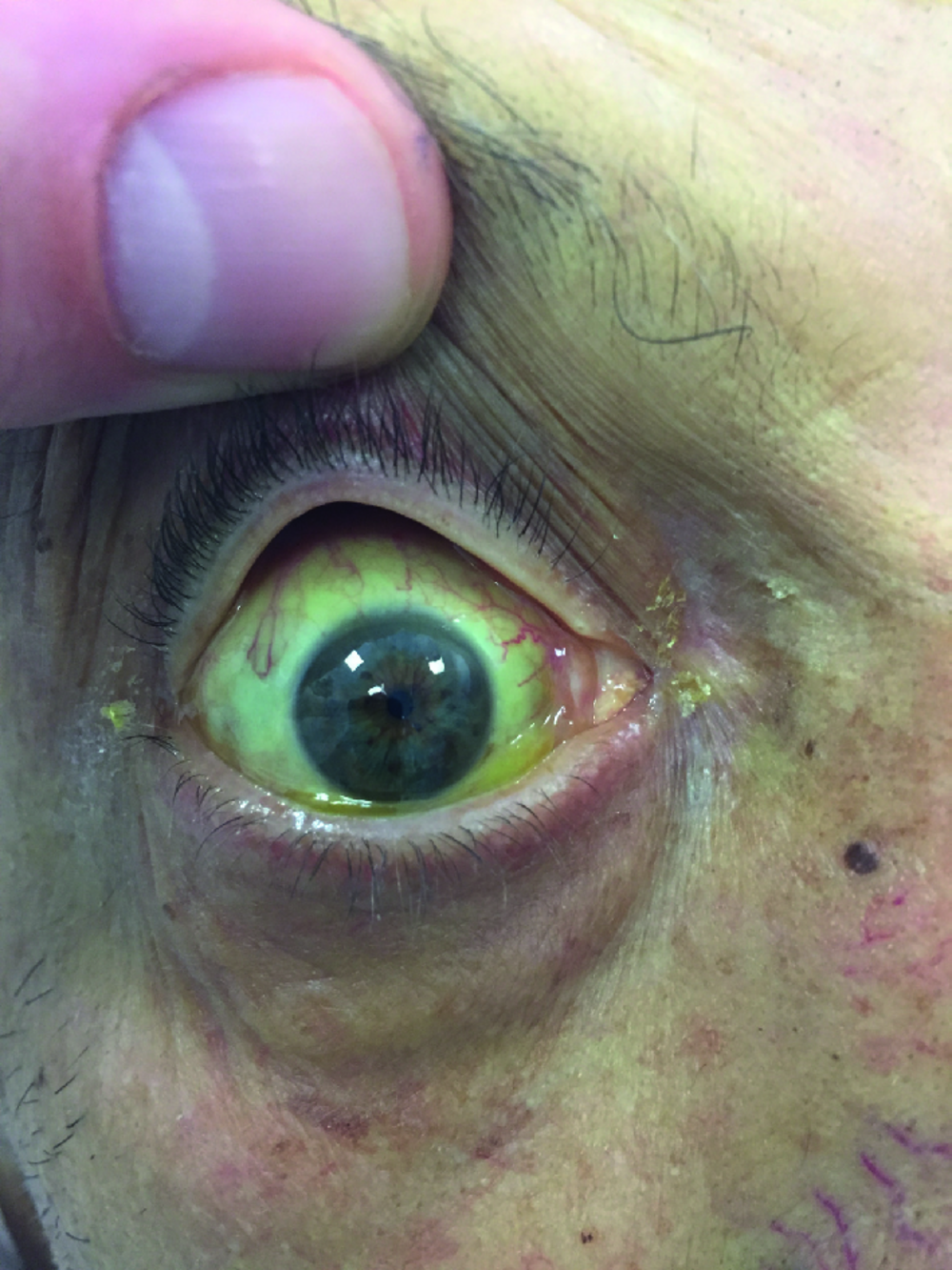 Photographie de l'œil du patient, paupière supérieure relevée