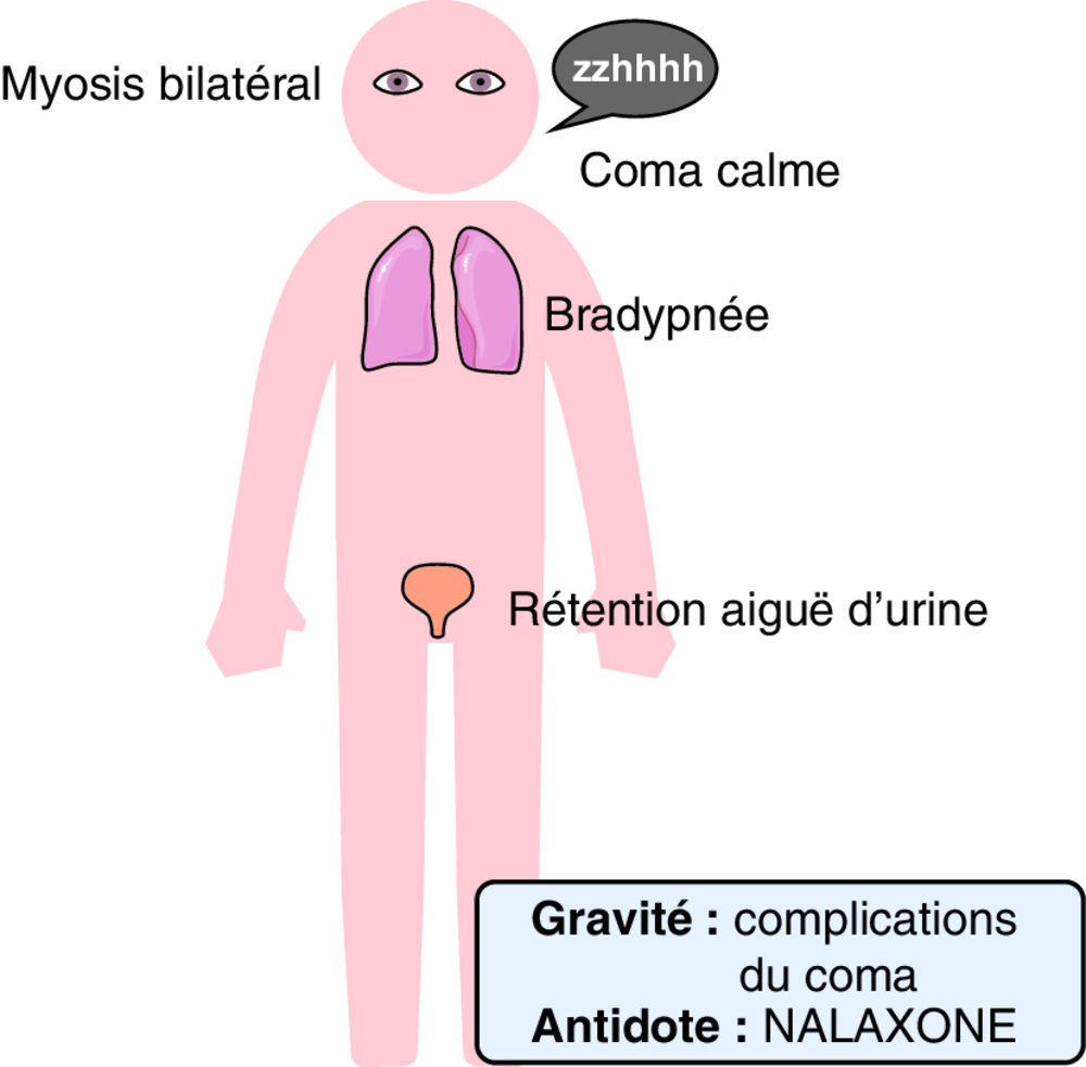 A Toxidrome morphinique ou opioïde
