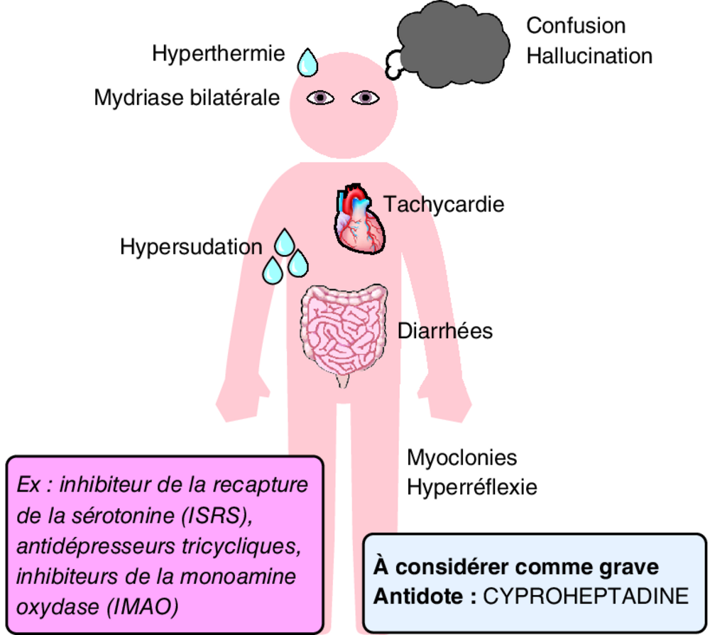 B Toxidrome sérotoninergique