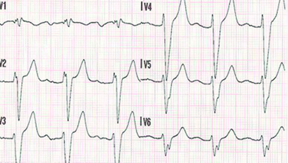 Extrait d'ECG des dérivations précordiales V1 à V6