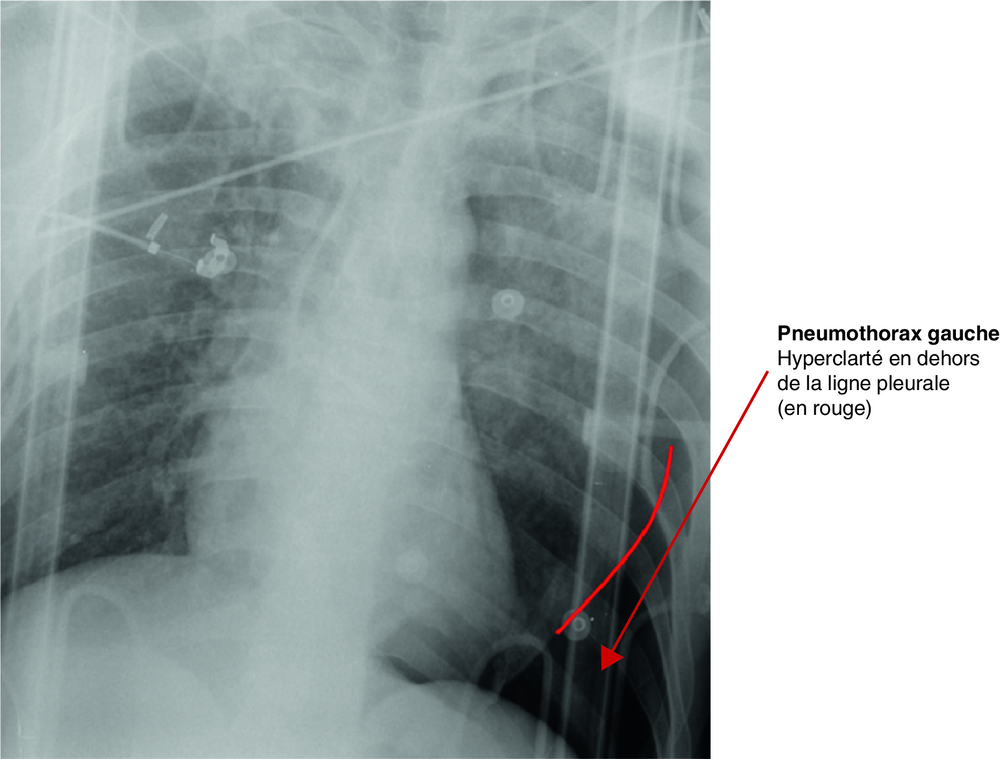 A Radiographie thoracique d’un patient de 34 ans, chute de 6 mètres