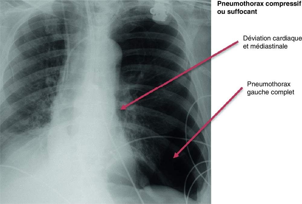 A Pneumothorax gauche complet suffocant