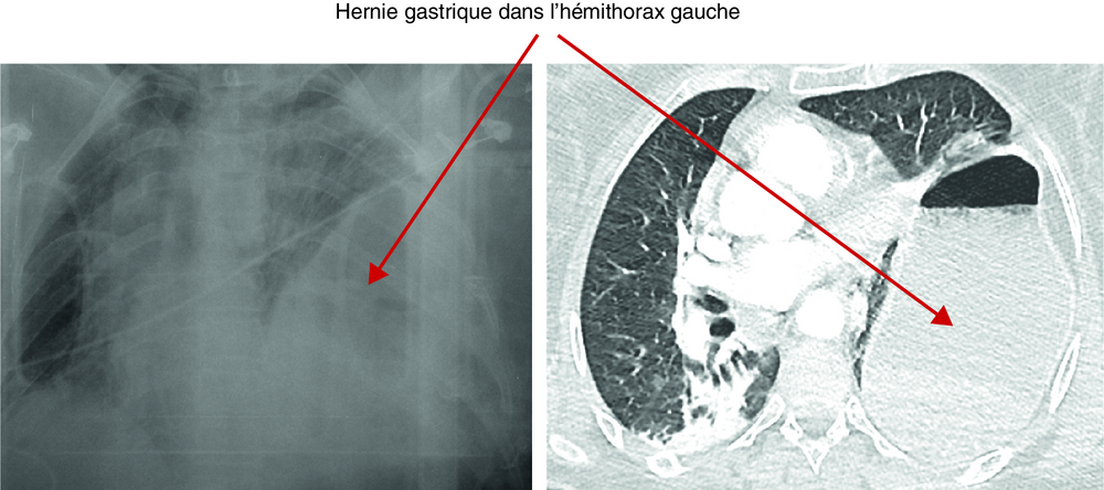 A Radiographie et scanner thoraciques chez une patiente défenestrée de 54 ans. Rupture diaphragmatique gauche