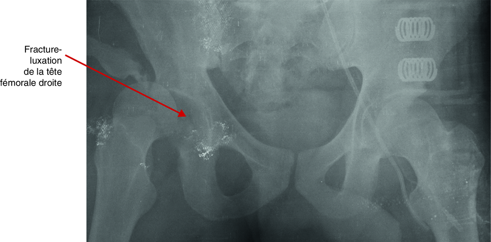 A Radiographie du bassin chez un homme de 25 ans renversé par un véhicule léger