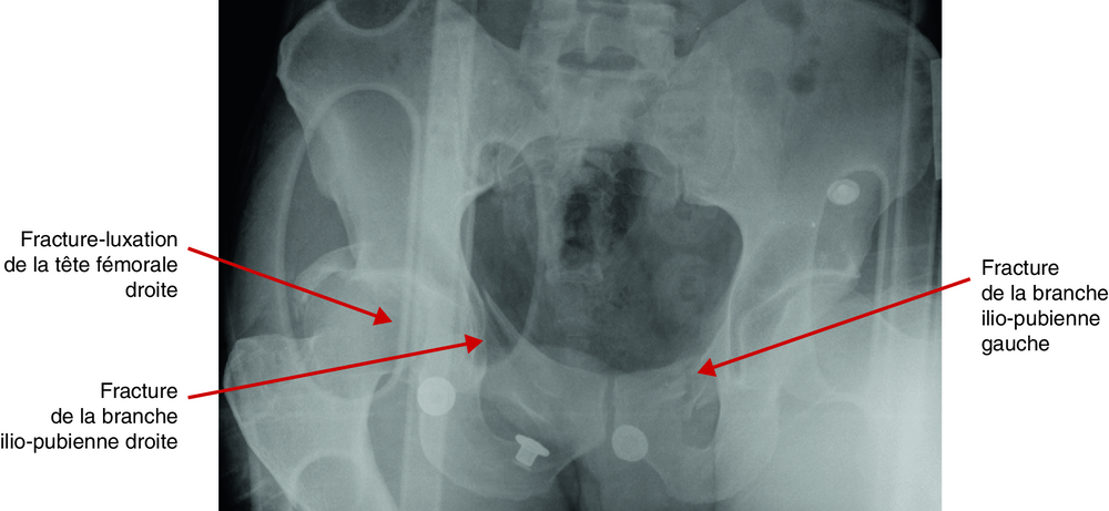 A Radiographie du bassin chez un homme de 38 ans défenestré
