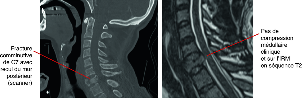 A Homme de 37 ans, défenestration, fracture