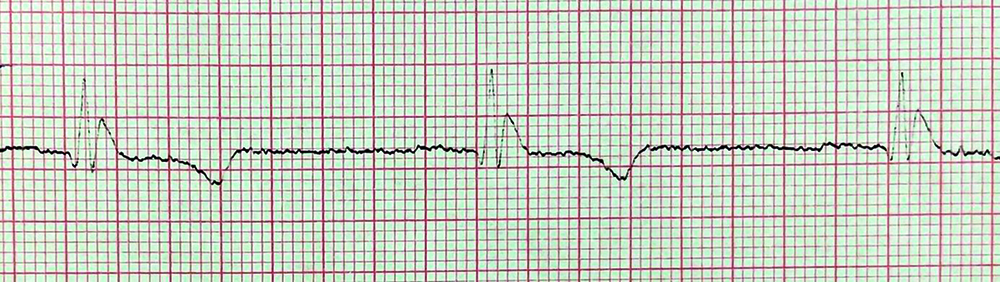 Tracé ECG en dérivation DII du patient