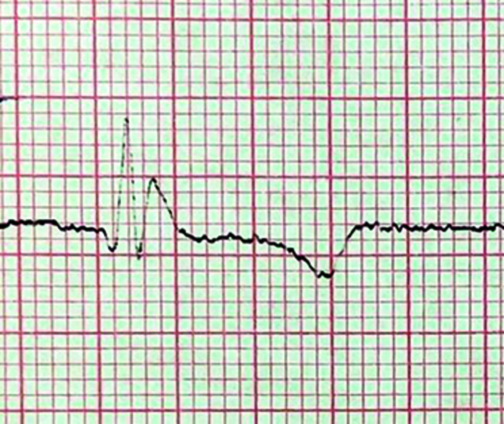 Extrait d'ECG du patient sur papier millimétré