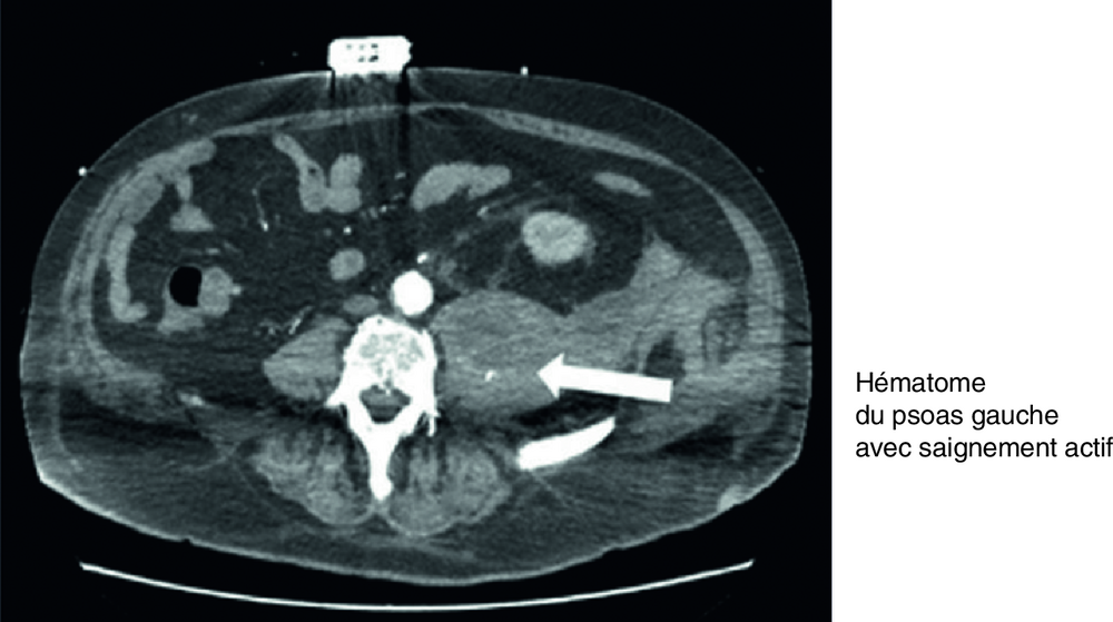 Coupe de scanner abdominopelvien avec injection de produit de contraste, une flèche désignant une zone de la région lombaire gauche