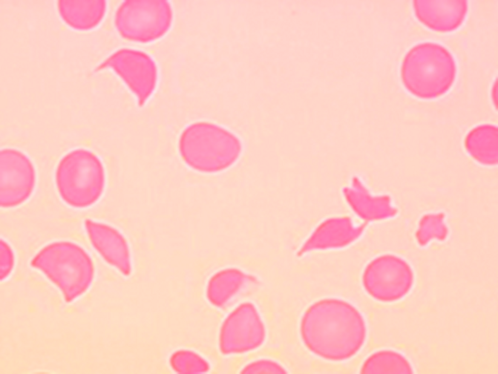 A Le frottis sanguin met en évidence des schizocytes avec un aspect dit en « bicorne » ou en « cimier de casque ». Cette image est caractéristique des syndromes de MAT