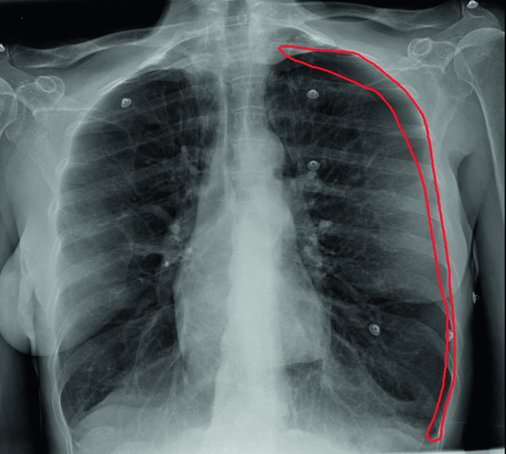 Radiographie thoracique de face avec une zone entourée en rouge sur l'hémithorax gauche (corrigé)