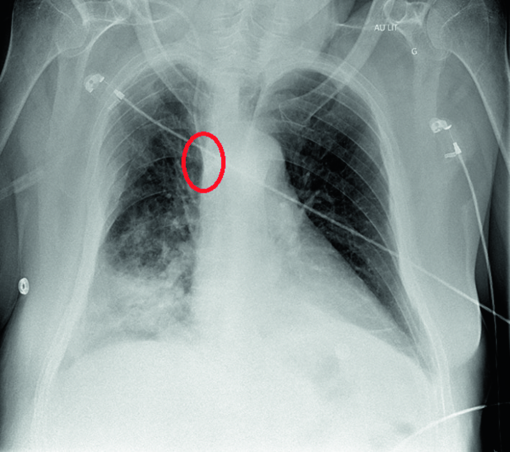 Radiographie thoracique de face avec une zone entourée en rouge (corrigé)