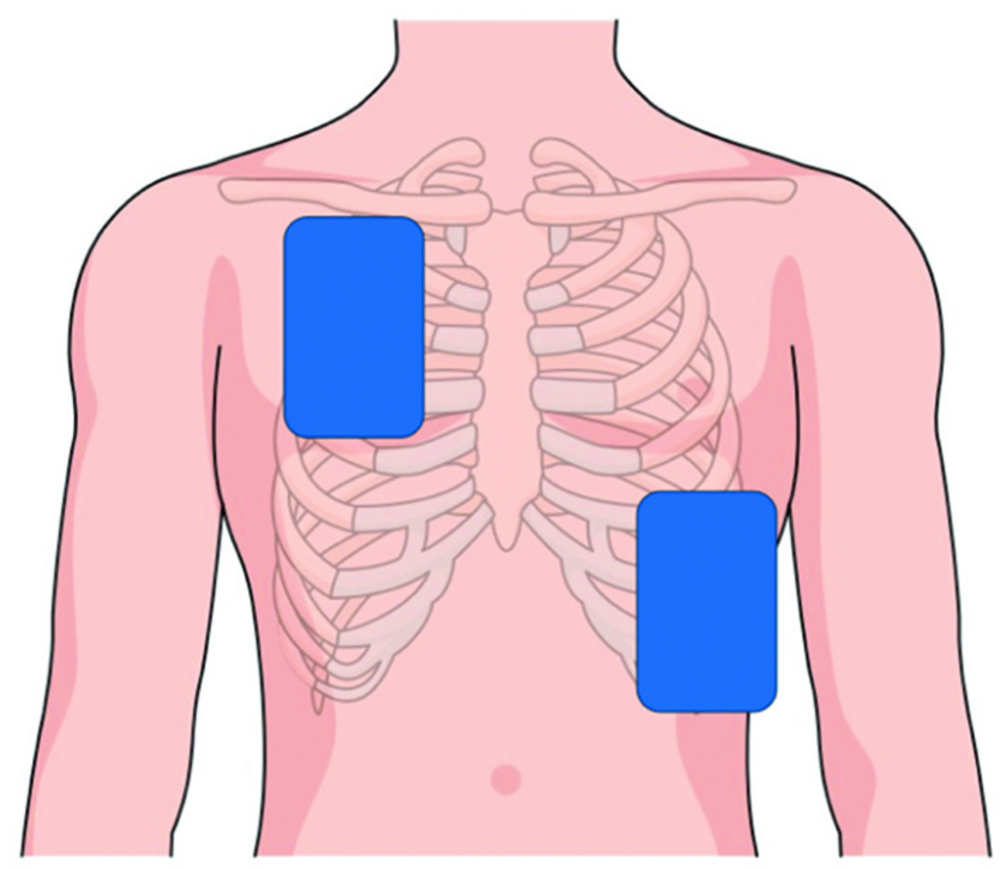 Schéma du thorax avec positionnement de deux électrodes de défibrillation (corrigé)