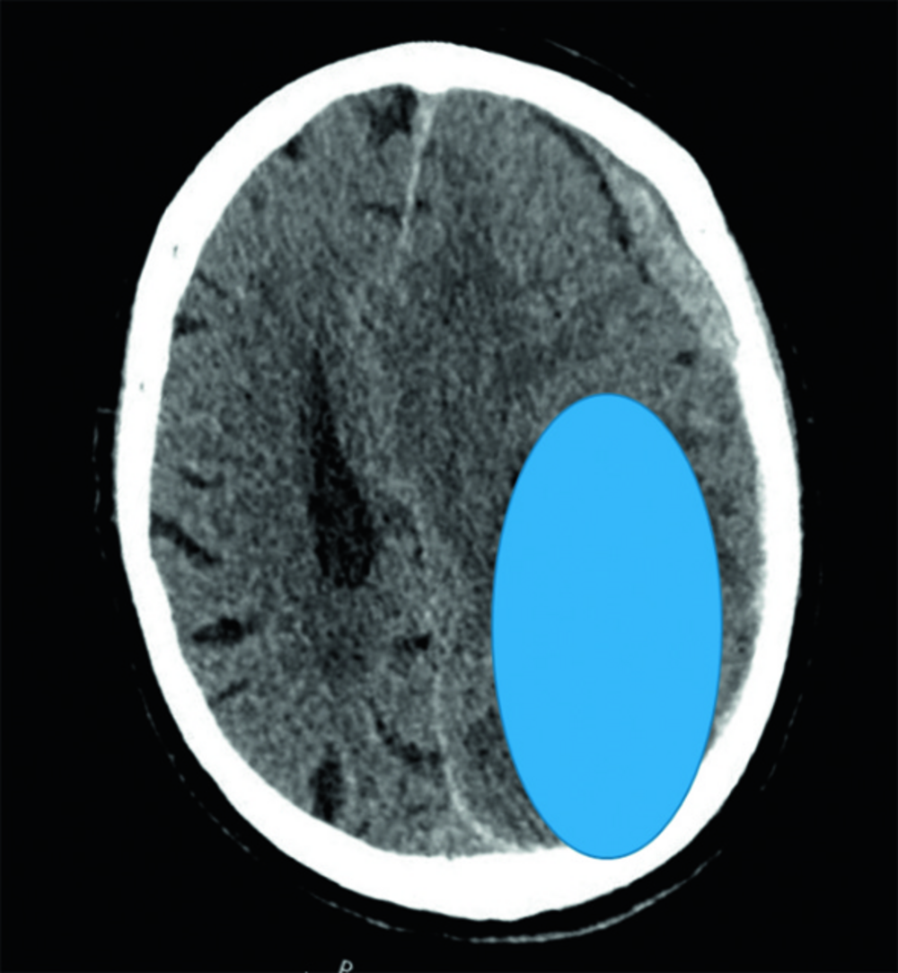 Coupe de scanner cérébral sans injection avec une zone ovale bleue superposée, correction d'une question de repérage